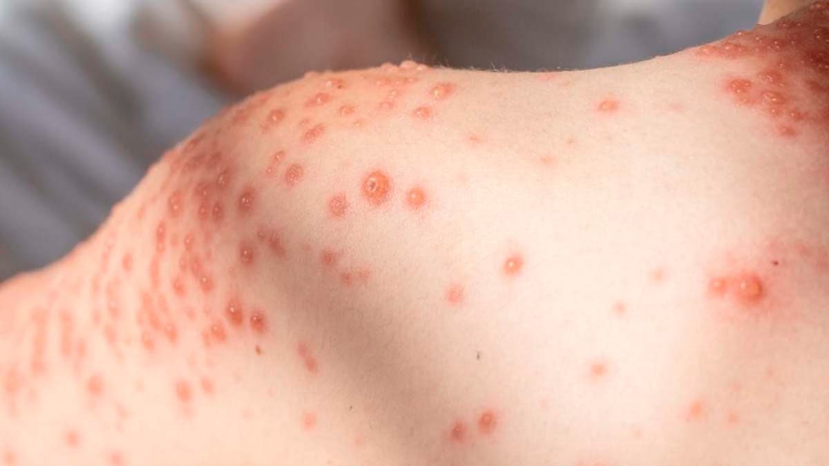 Alerta Epidemiológico: Marataízes Enfrenta Surto de Varicela