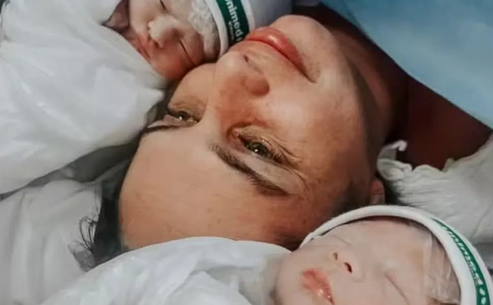 Milagre Neonatal: Gêmeos Nascem Empelicados em Vitória