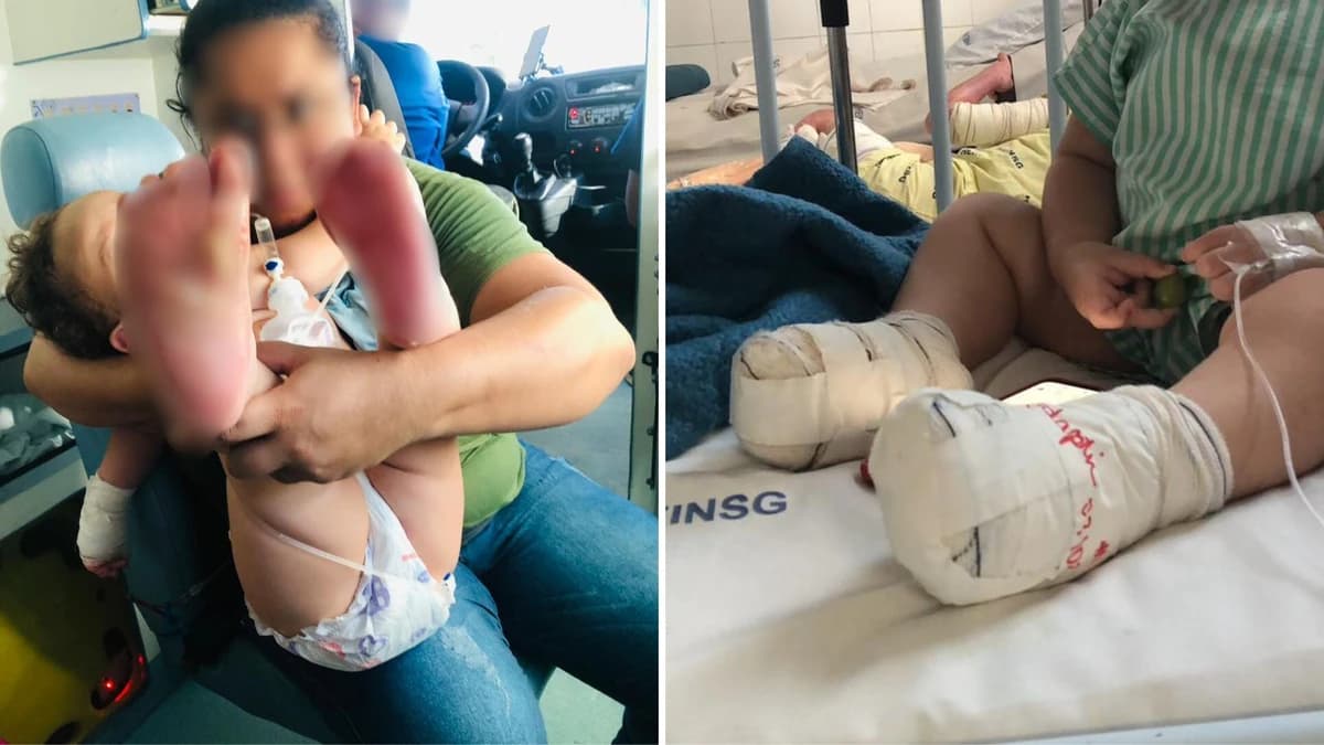 Bebê Sofre Queimaduras Graves em Creche e Mãe Questiona Socorro